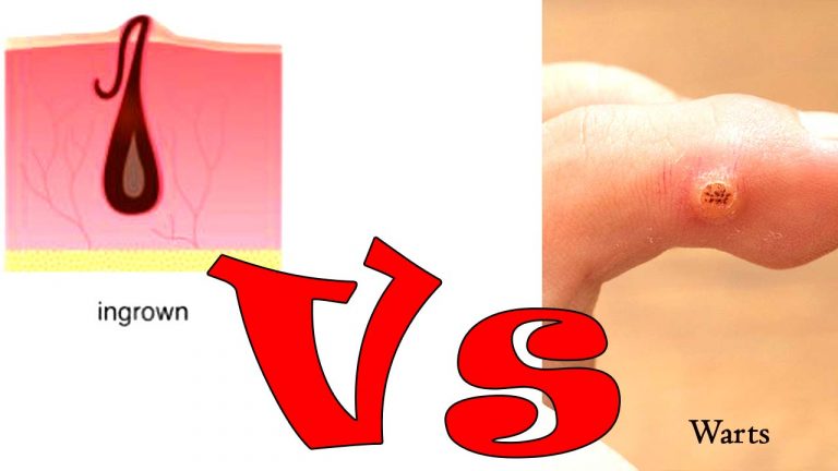 Difference Between Ingrown Hair And Genital Warts